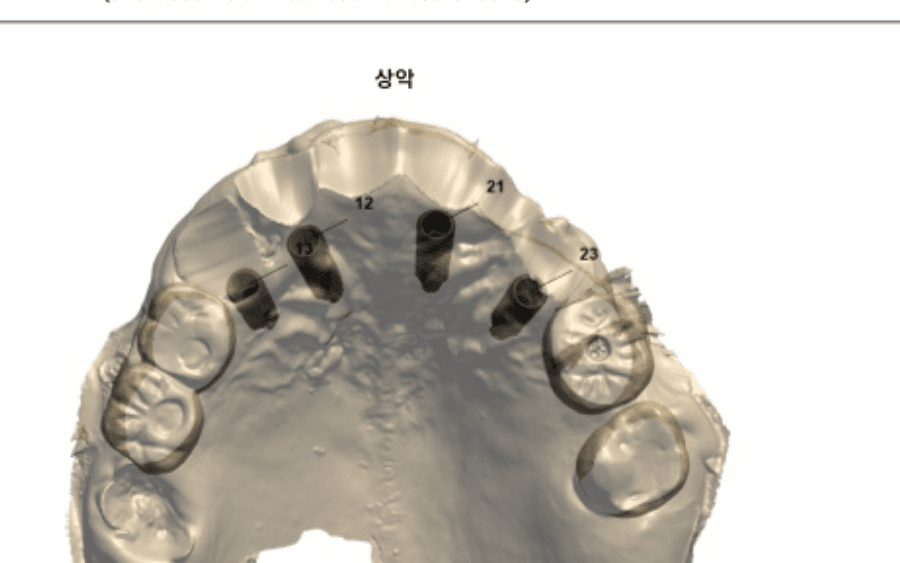 네비게이션 임플란트 치료 과정 1단계 - 3D 정밀 진단 및 식립 계획