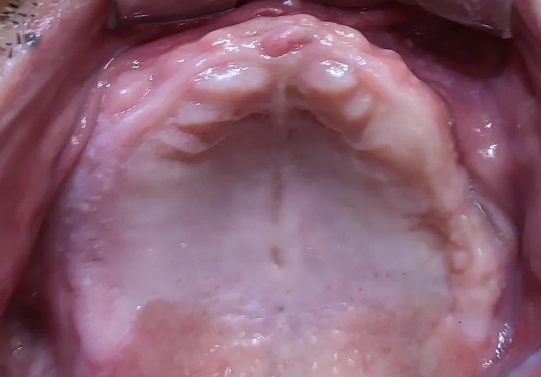 전악 임플란트 치료 전 상악 구강 사진