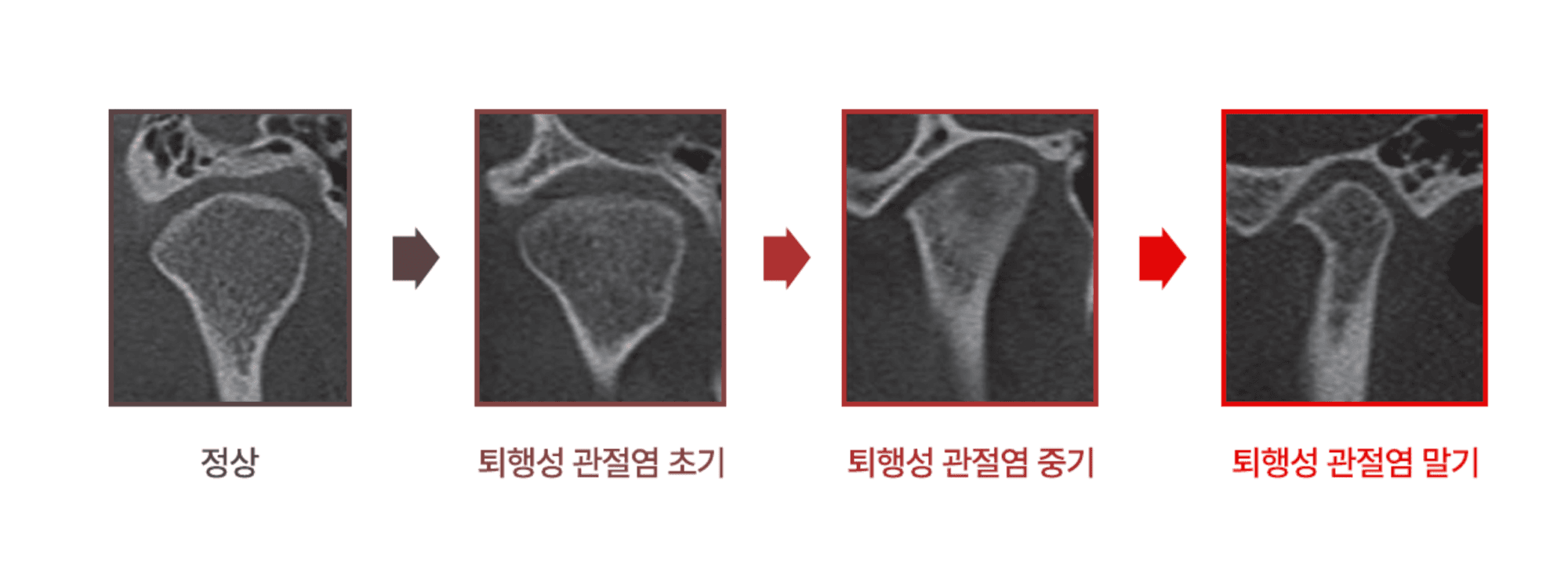 턱관절 퇴행성 관절염의 진행 단계 - 정상, 초기, 중기, 말기 CT 비교