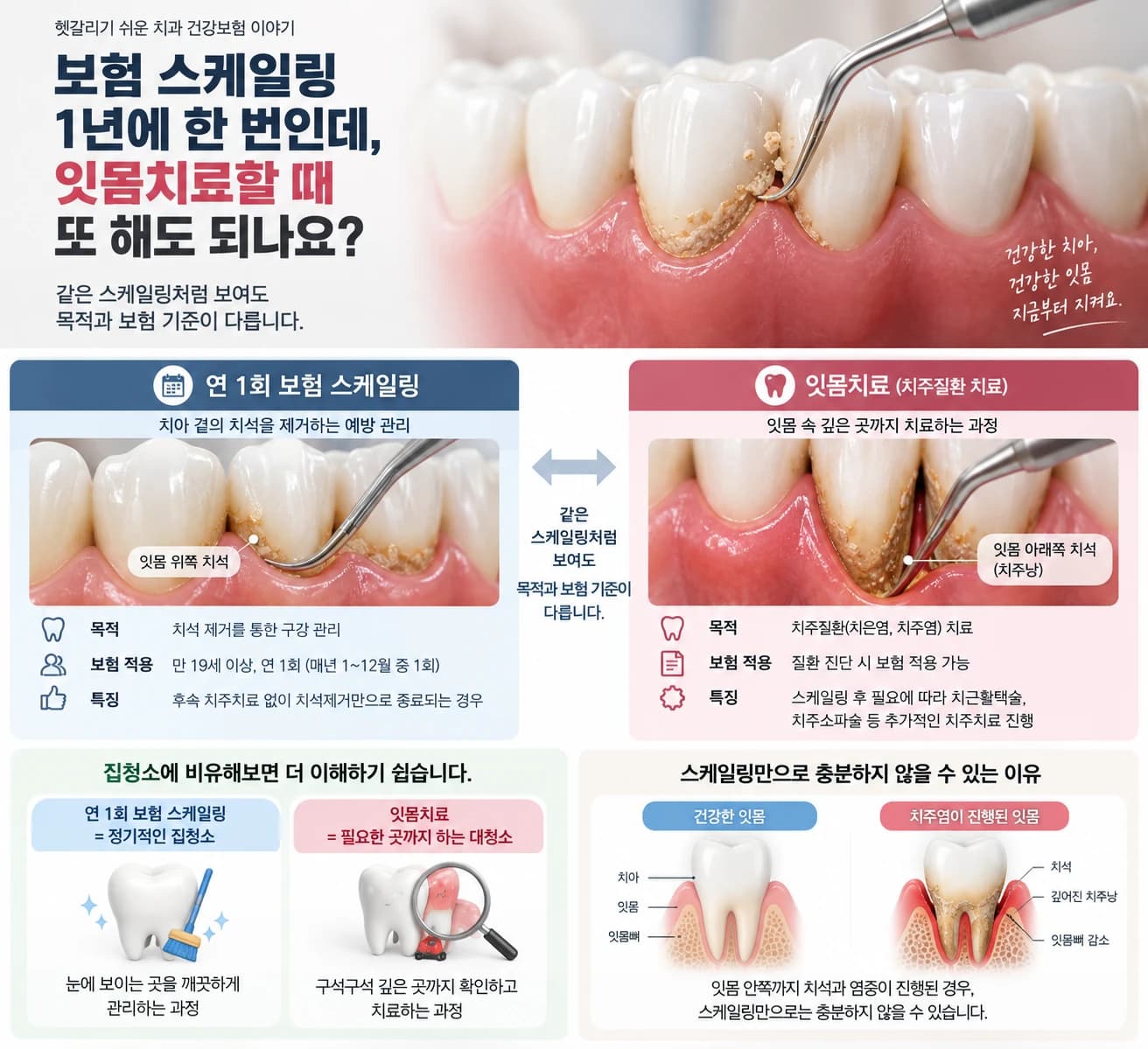 연 1회 스케일링과 치주질환 치료의 차이를 정리한 원문 안내