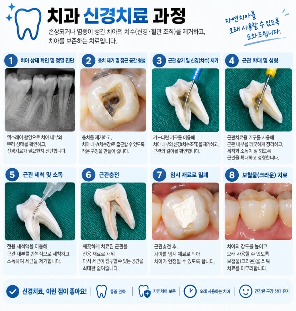 실제 치아 사진과 그림으로 구성한 신경치료 단계별 설명 자료