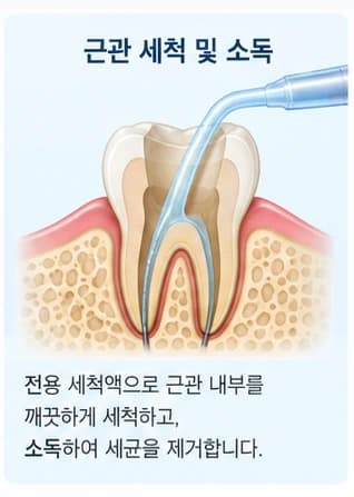 세척액을 이용한 근관 세척과 소독을 설명하는 원문 그림