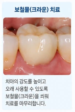 원문에 제시된 크라운 보철치료 설명 이미지