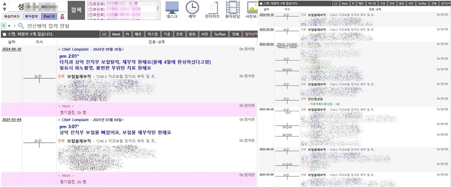 보철물 탈락과 재부착 경과를 보여주는 원문 진료기록