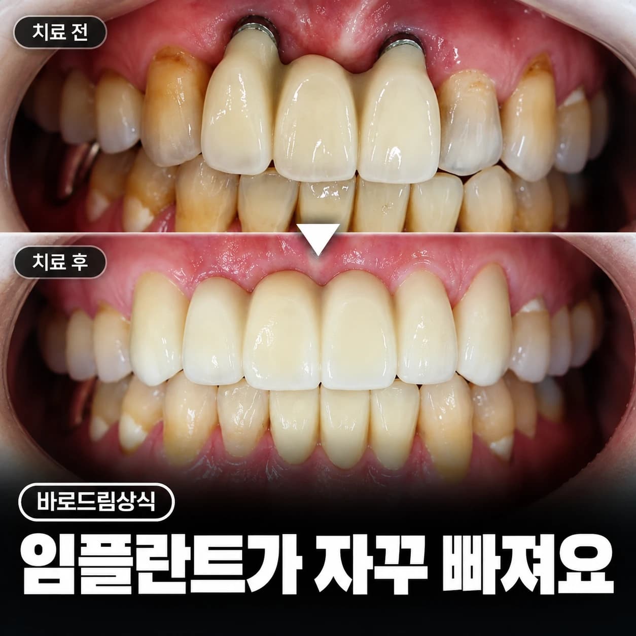 앞니 임플란트 보철 재치료 전후 구강사진을 배치한 원문 표지