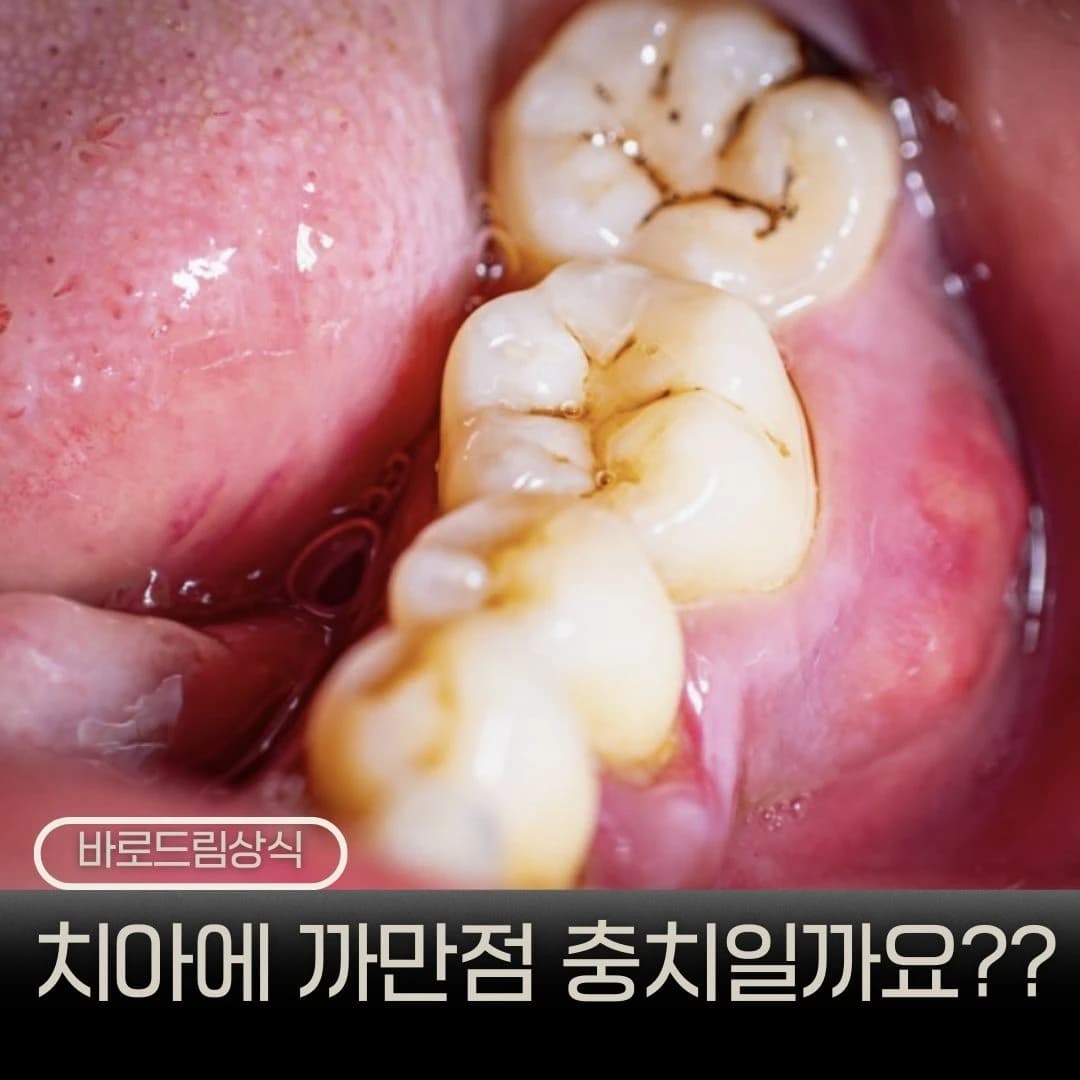 어금니의 검은 홈을 보여주는 원문의 충치와 착색 구분 안내 이미지