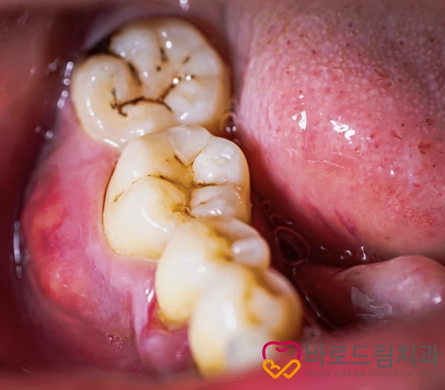 어금니 씹는 면의 검게 보이는 홈을 보여주는 원문 구강사진