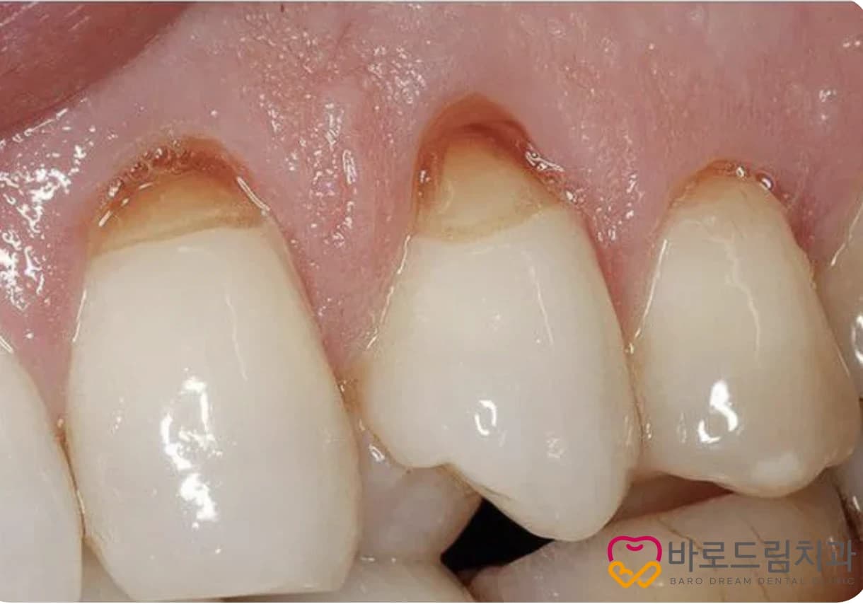 잇몸 경계와 치아 목 부분의 상태를 보여주는 원문 구강사진