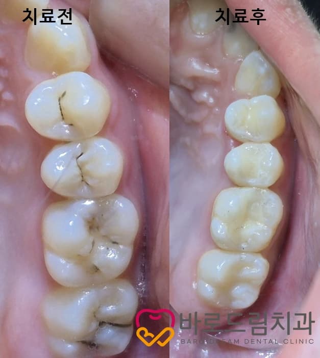 원문에 치료 전과 치료 후로 나란히 표시된 어금니 구강사진