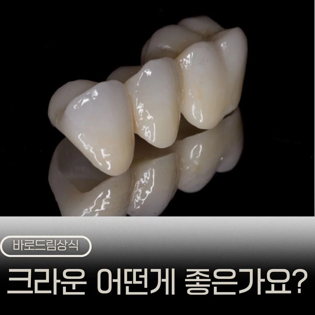 치아색 크라운 보철물을 보여주는 원문의 크라운 선택 안내 이미지