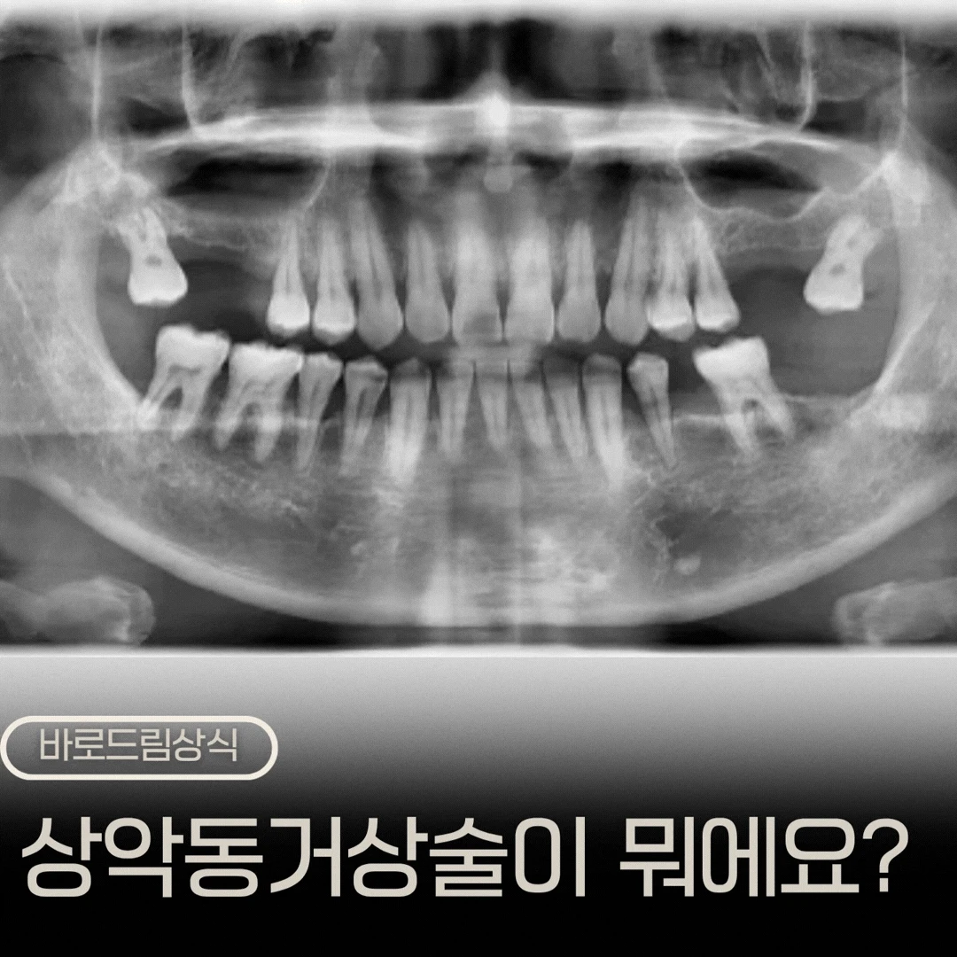 원문에서 치료 전후 파노라마를 번갈아 보여주는 상악동 거상술 설명 GIF
