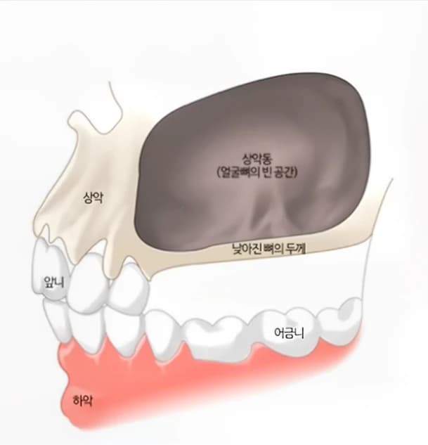 상악동과 위턱 치아의 위치 관계를 보여주는 해부학 설명 그림