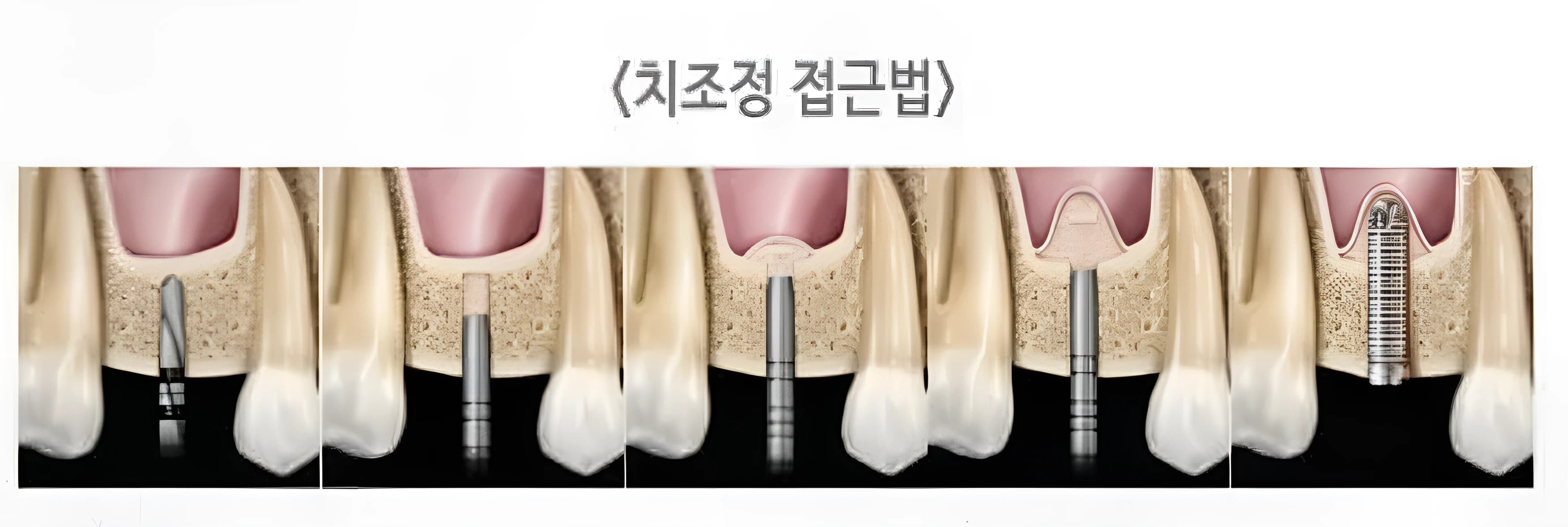 치아가 있던 자리에서 상악동으로 접근하는 치조정 접근법의 단계별 모식도