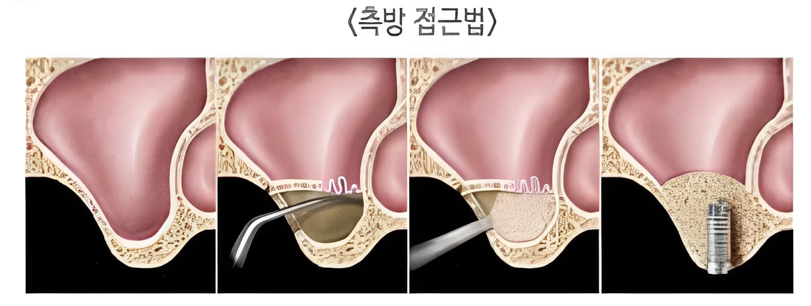 상악동 옆쪽 뼈에 창을 만들어 접근하는 측방 접근법의 단계별 모식도