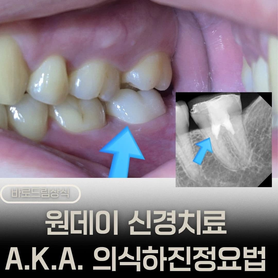 치아와 방사선 사진을 함께 배치하고 의식하진정법을 소개한 원문 대표 이미지