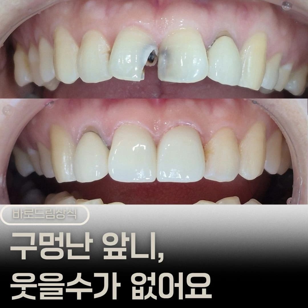 앞니 파절과 변색 부위의 치료 전후 사진을 배치한 원문 대표 이미지