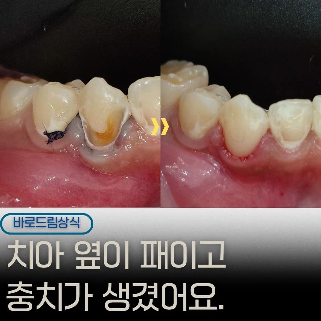 치경부 충치 부위의 레진 치료 전후를 배치한 원문 대표 이미지