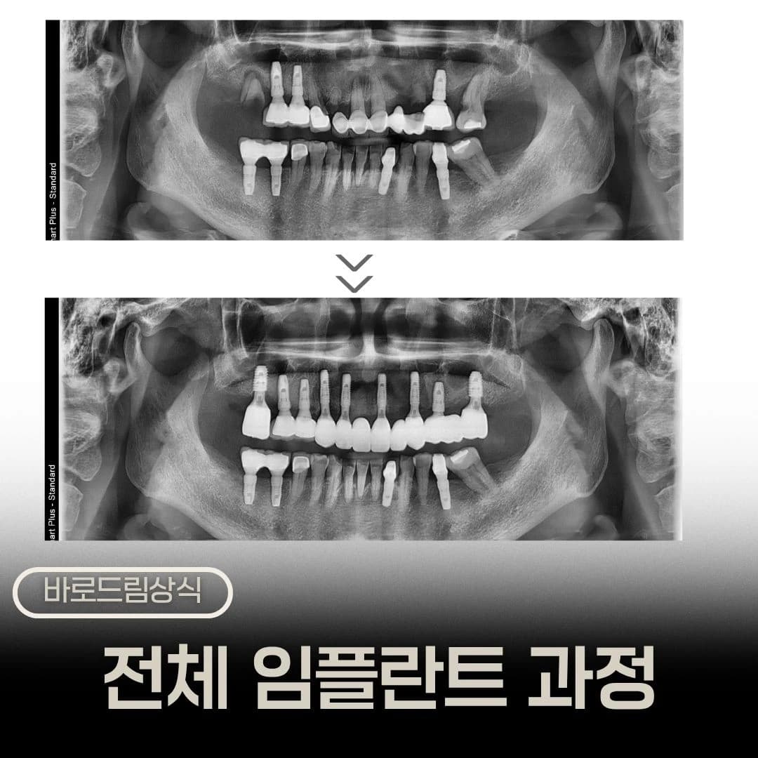 치료 전후 파노라마를 나란히 배치한 상악 재건 원문 대표 이미지
