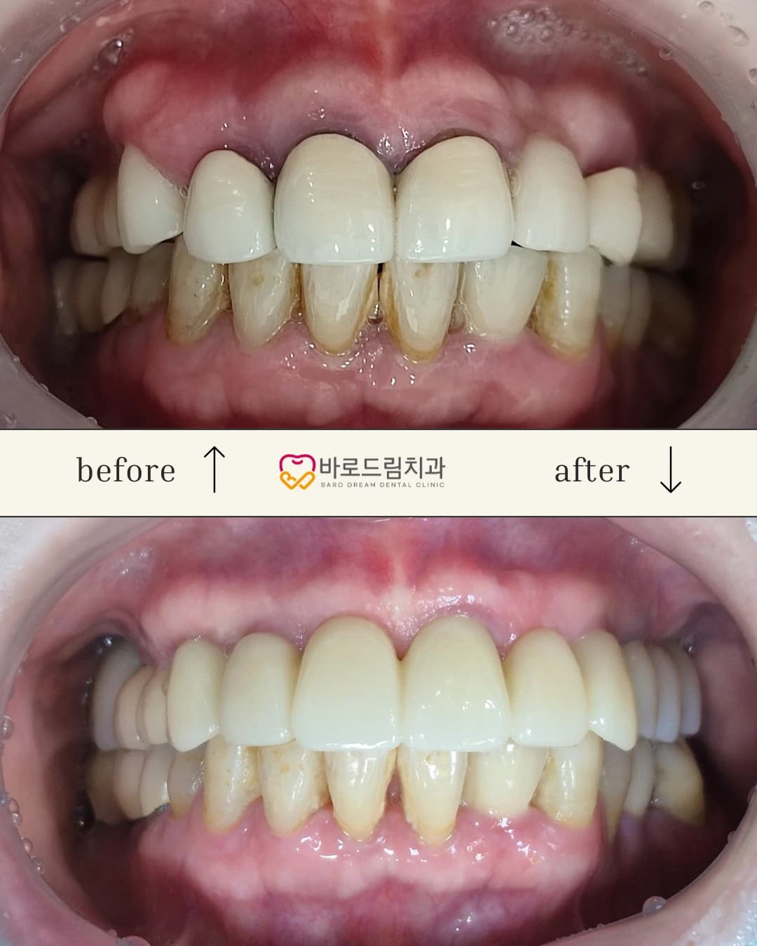 기존 보철 상태와 상악 재건 후 상태를 비교한 원문 정면 사진