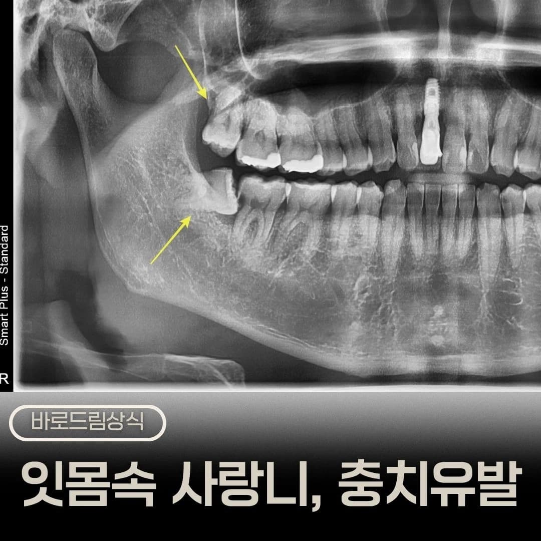방향이 좋지 않은 사랑니를 화살표로 표시한 원문 대표 이미지