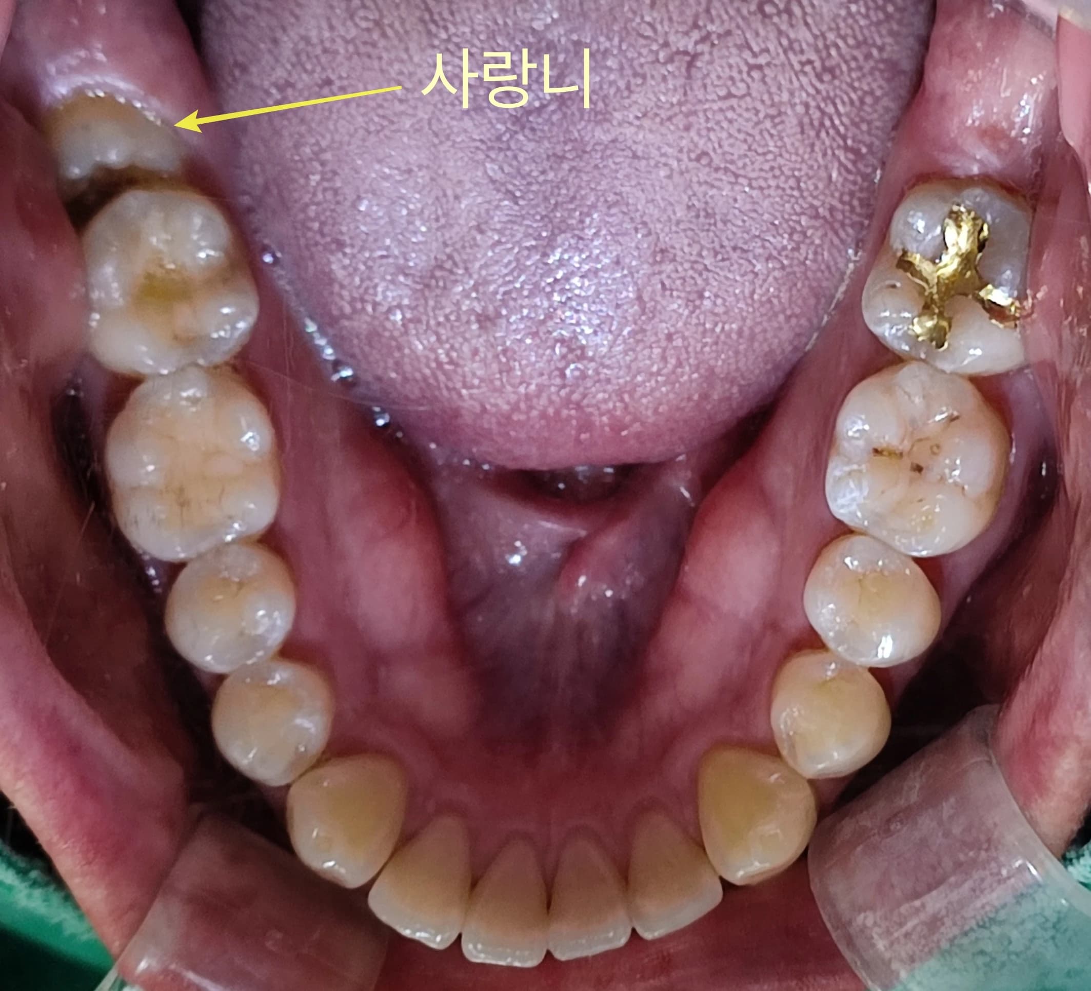 치열 맨 뒤 사랑니를 화살표로 표시한 아래 치열 구강사진