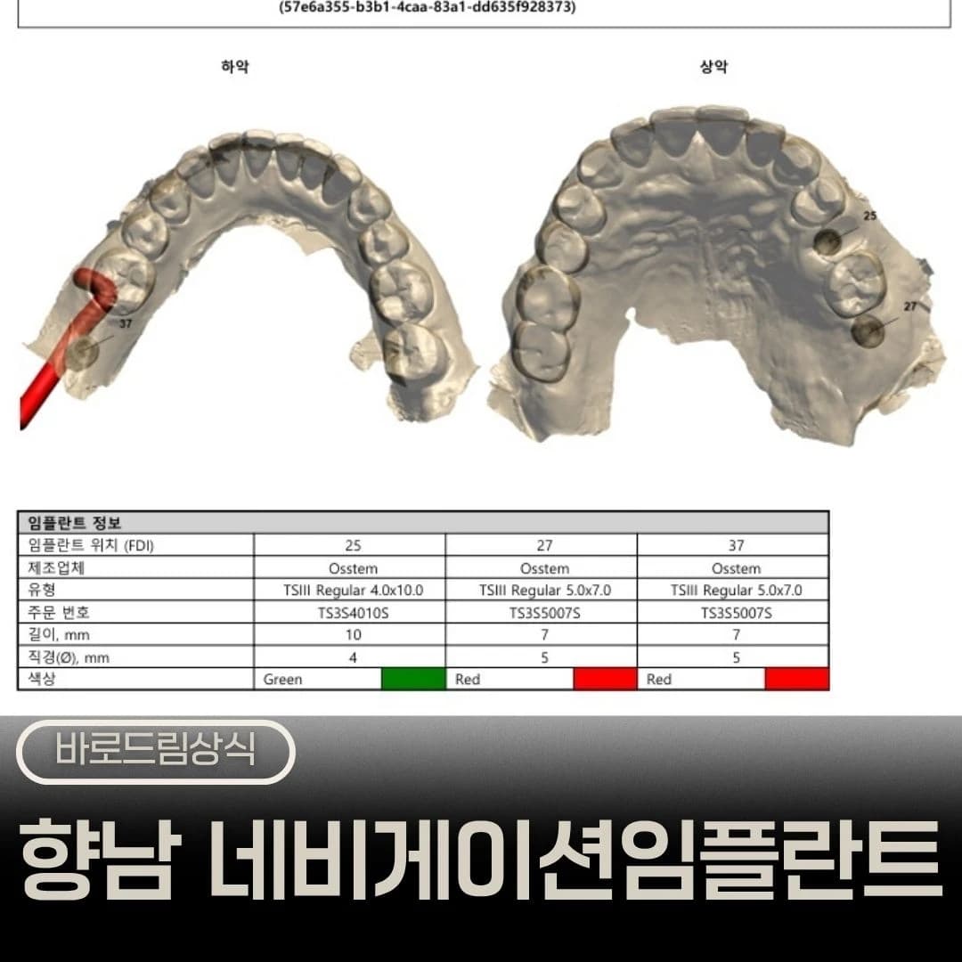 디지털 수술 가이드와 계획 자료를 배치한 원문 임플란트 대표 이미지