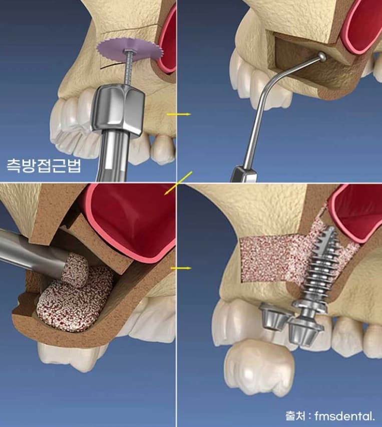 측방 접근으로 상악동막을 올리고 뼈이식하는 과정을 보여주는 원문 도식