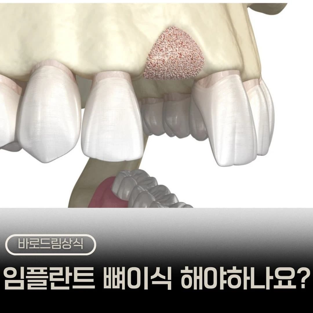 임플란트 뼈이식 필요성을 소개한 원문 대표 이미지
