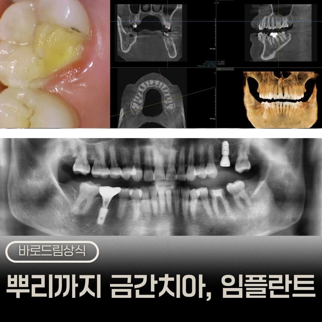 손상된 어금니와 CT·파노라마를 함께 배치한 원문 표지