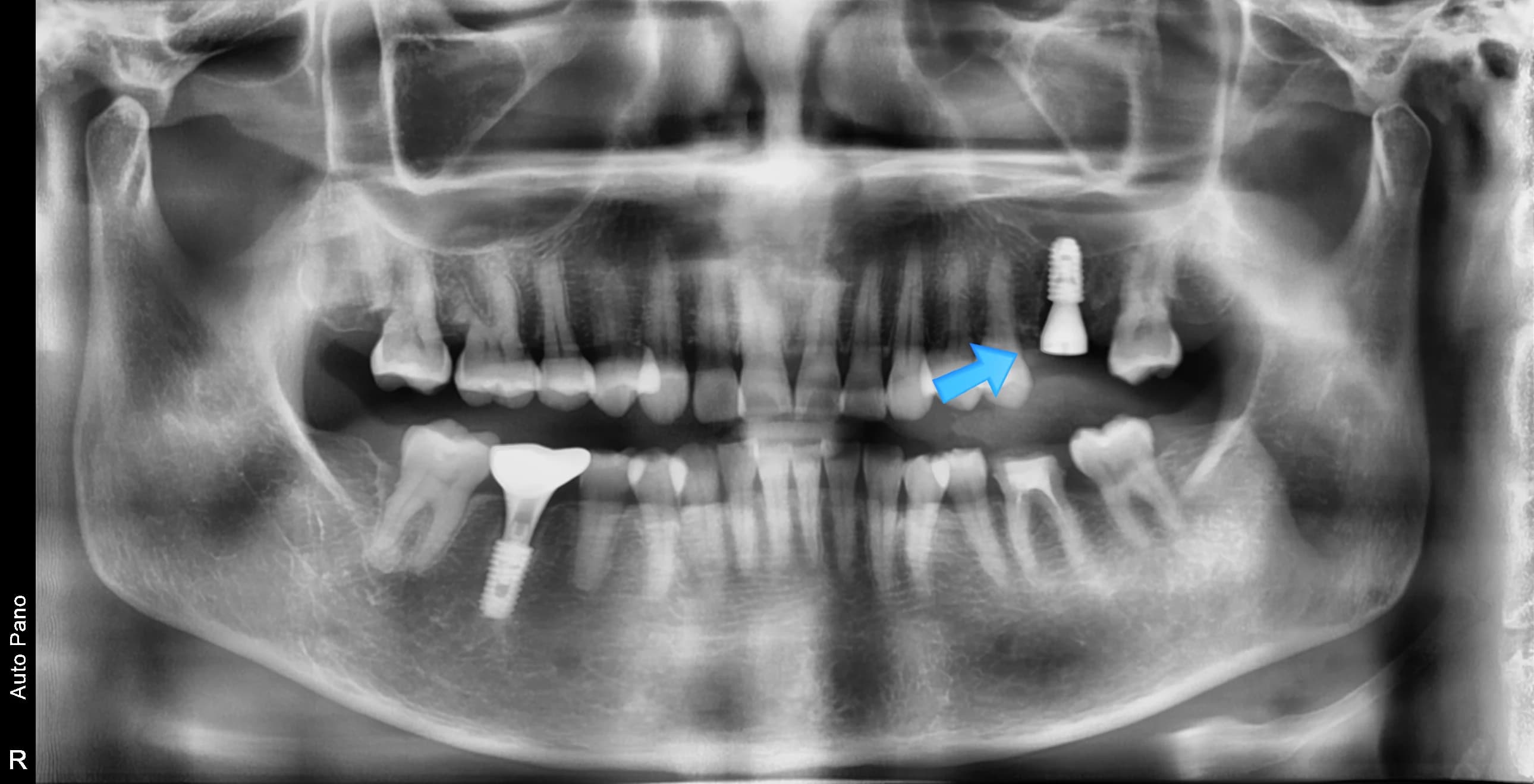 임플란트 위치를 파란 화살표로 표시한 파노라마