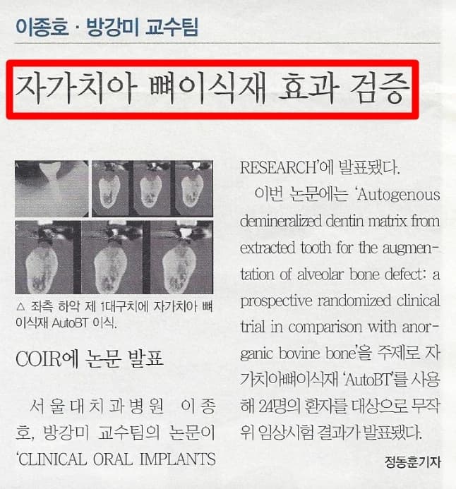 자가치아 뼈이식을 소개하는 원문의 설명 자료