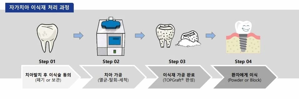 자가치아 뼈이식재 가공 순서를 설명한 원문 그림