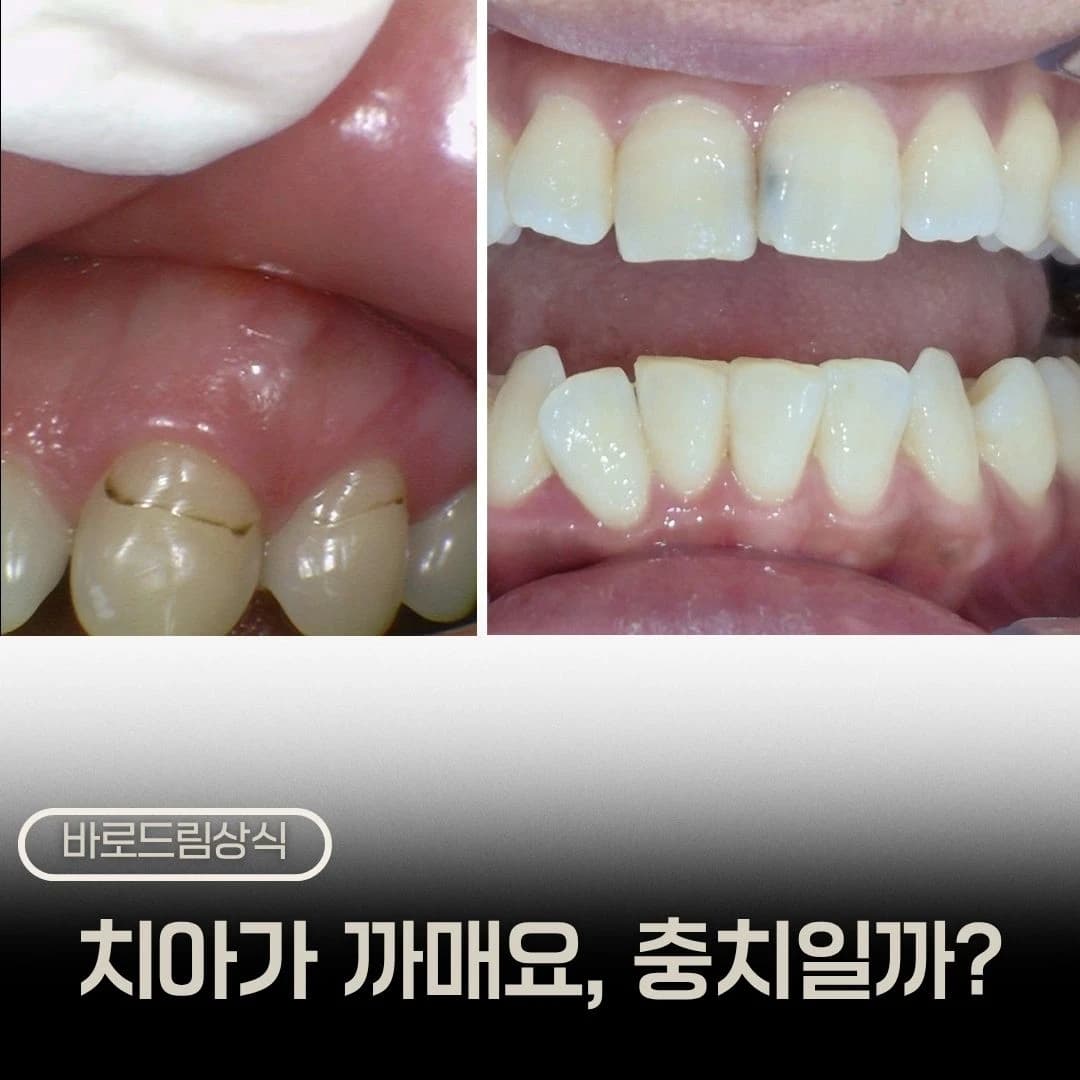 레진 착색과 충치 사진을 함께 배치한 원문 표지