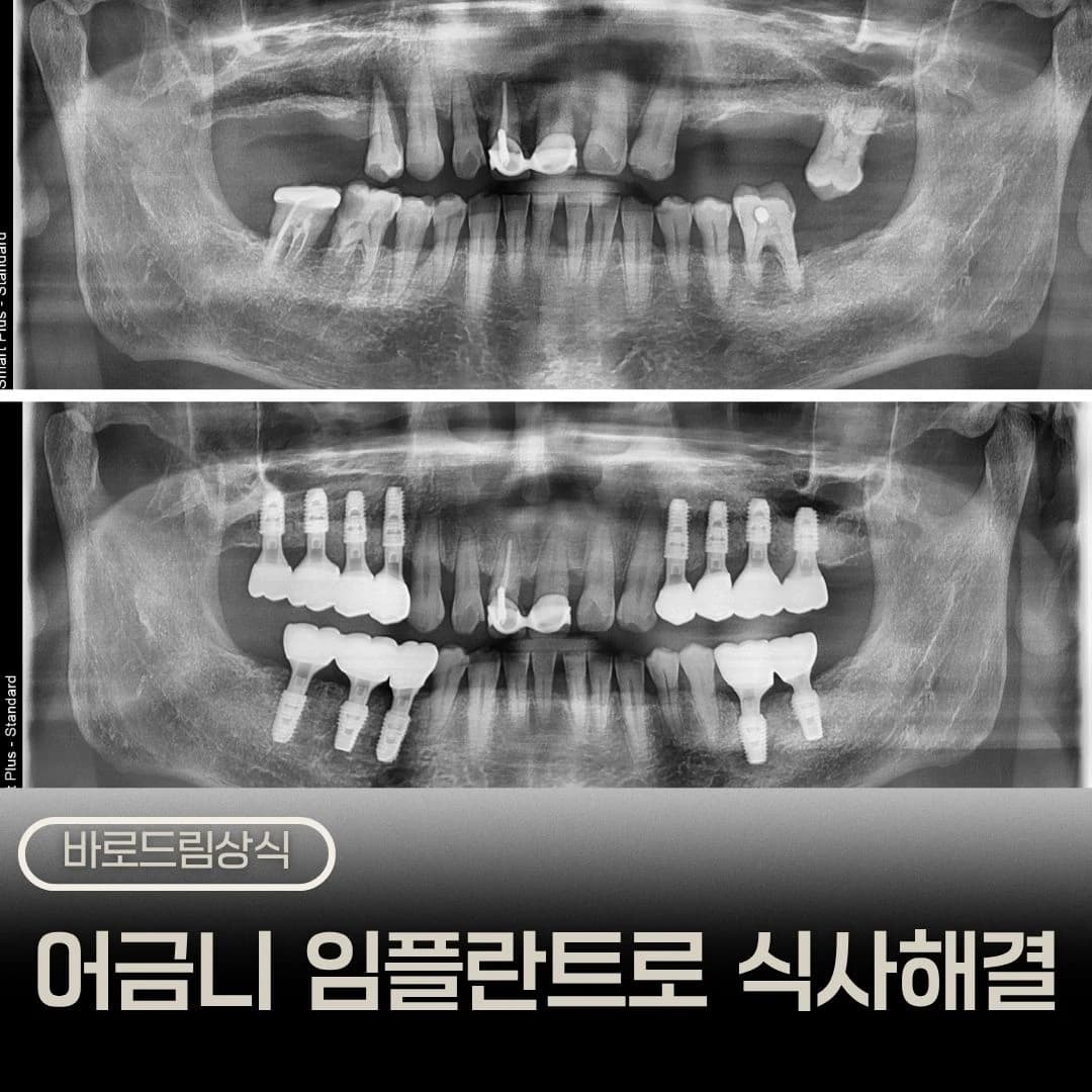 흡연과 임플란트 치료를 주제로 구강사진을 배치한 원문 대표 이미지