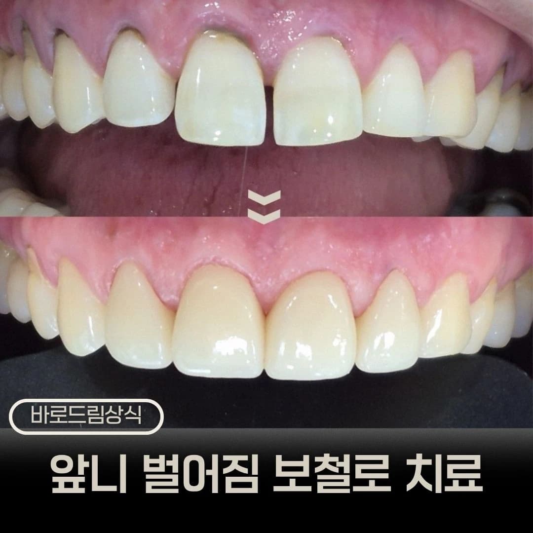 상악 앞니 벌어짐과 보철 치료를 소개한 원문 대표 이미지