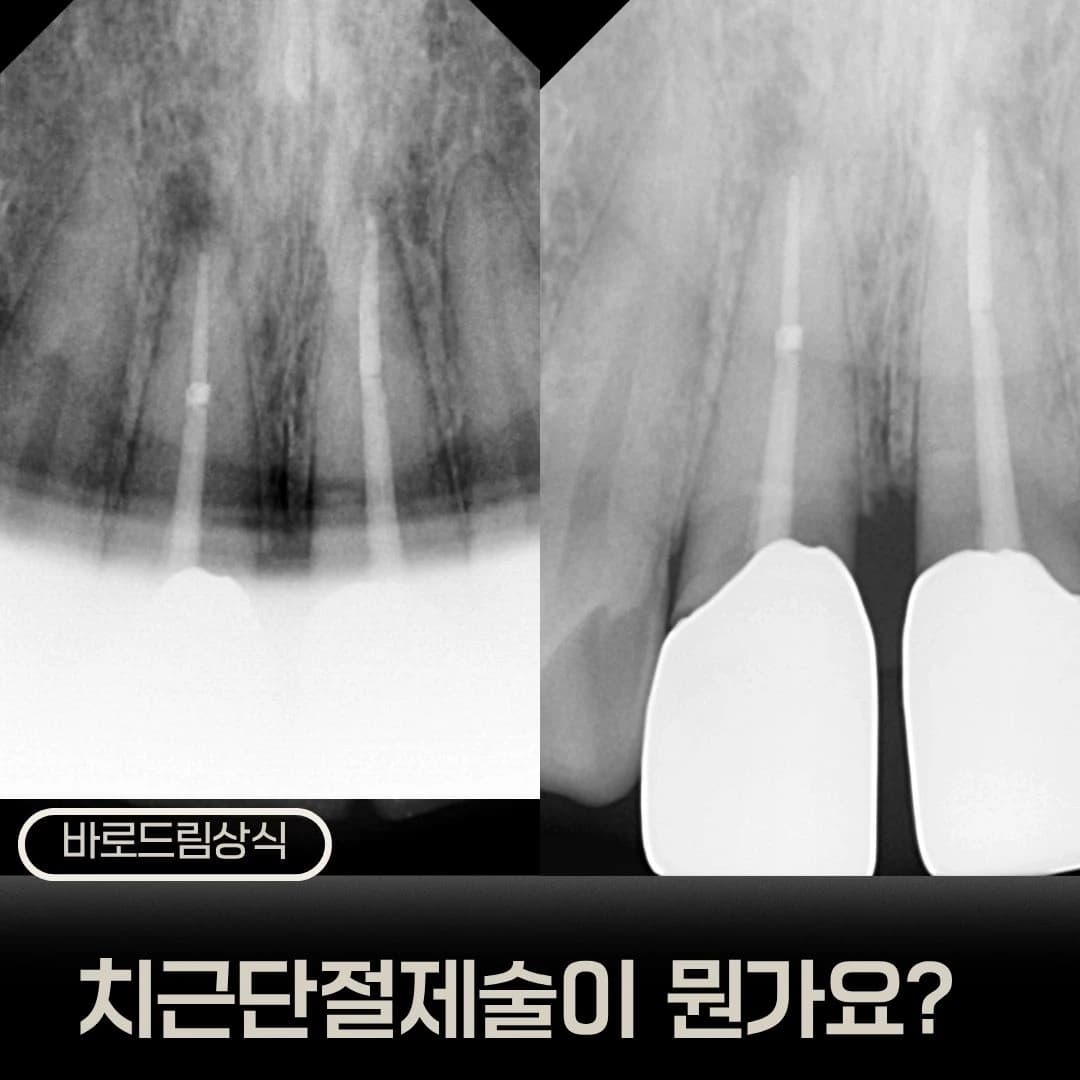 앞니 뿌리끝 방사선 사진을 비교한 원문 치근단절제술 표지
