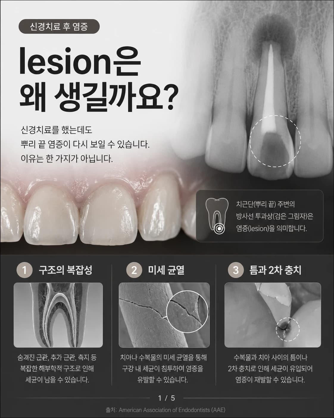 신경치료 후 뿌리끝 병소의 원인을 정리한 원문 교육 이미지