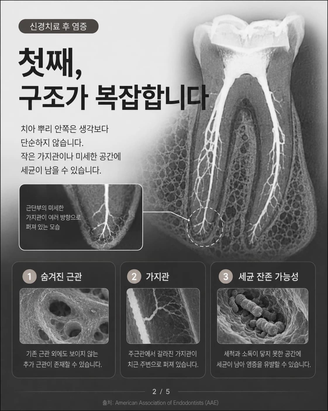 복잡한 근관과 가지관을 설명한 원문 교육 이미지