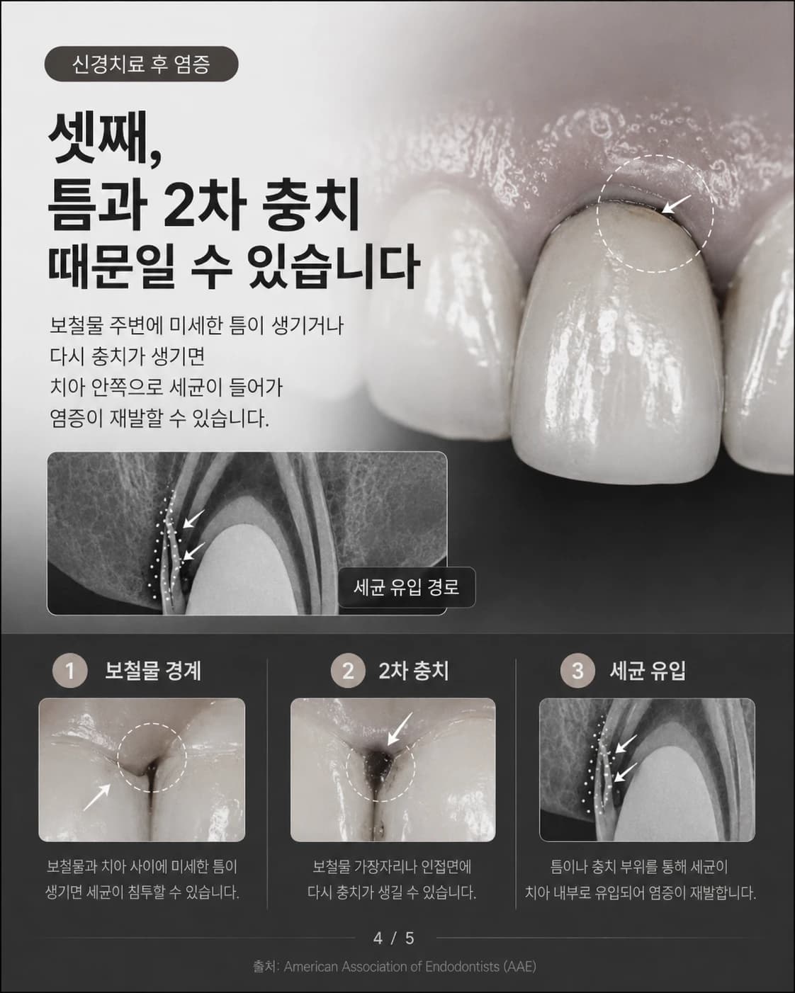 보철 경계 누출과 이차 충치를 설명한 원문 교육 이미지