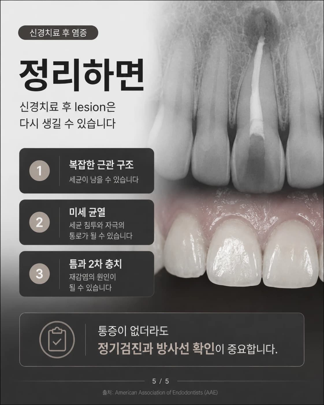 신경치료 후 뿌리끝 병소와 정기검진을 정리한 원문 교육 이미지