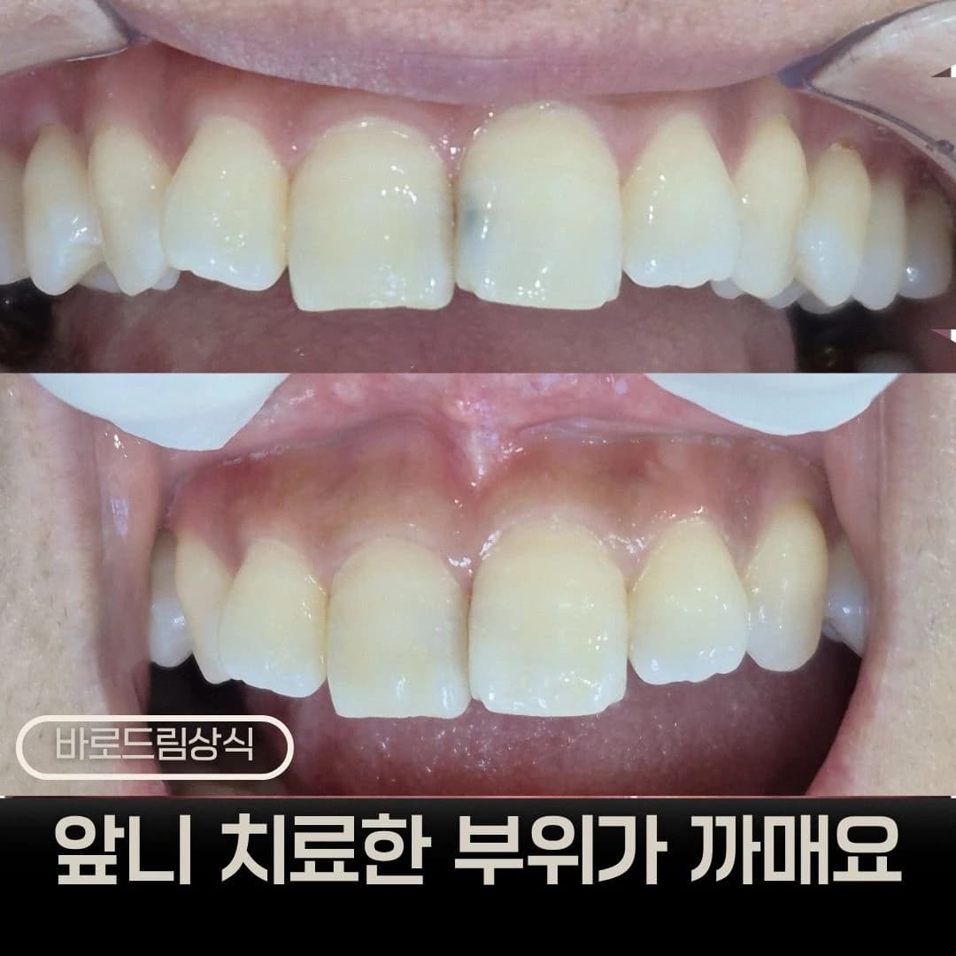 앞니 레진 치료 전후를 배치한 원문 표지