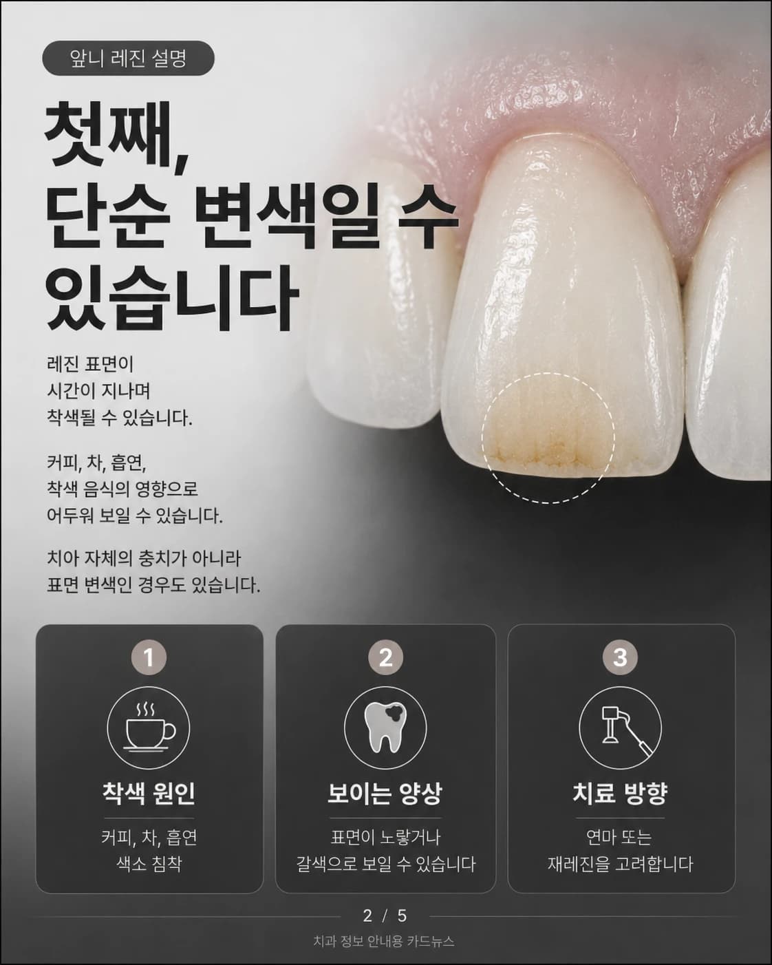 단순 레진 착색을 설명한 원문 교육 이미지