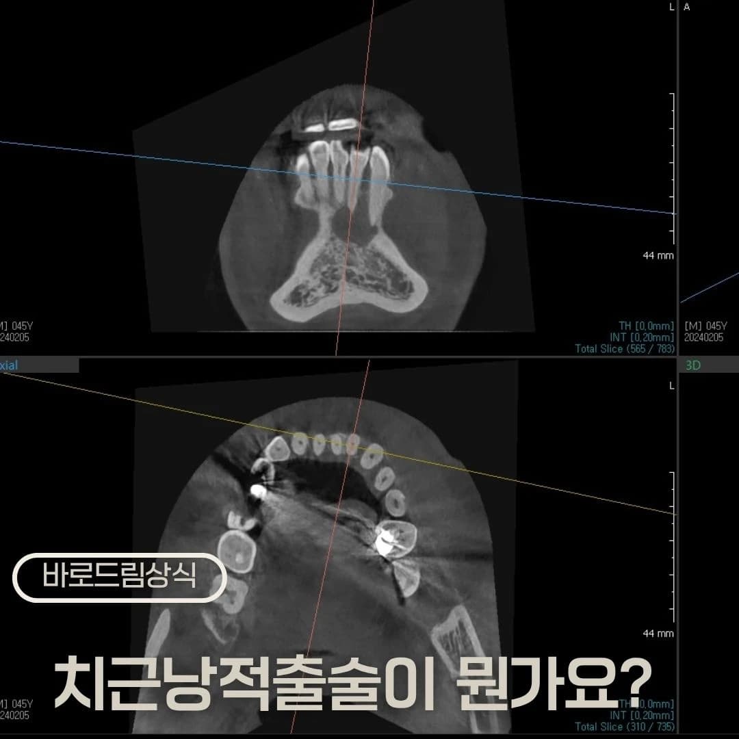 아래 앞니 구강사진과 뿌리 끝 부위 영상을 배치한 원문 대표 이미지