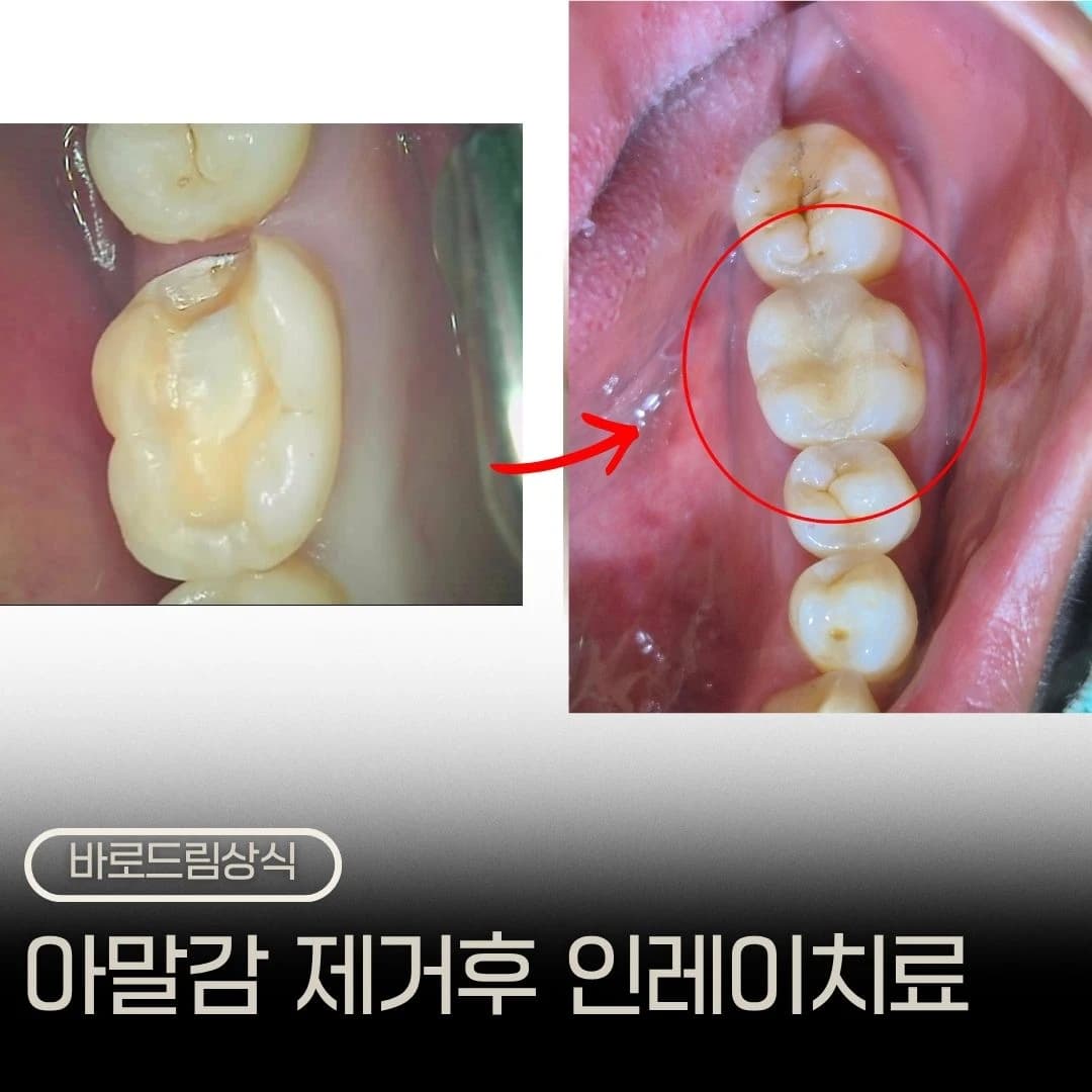 오래된 아말감과 금 인레이의 구강사진을 배치한 원문 대표 이미지