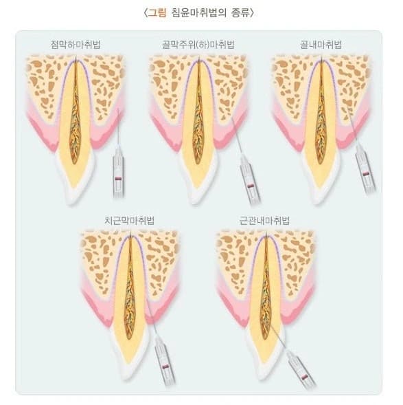 표면마취제 도포를 설명한 원문 사진