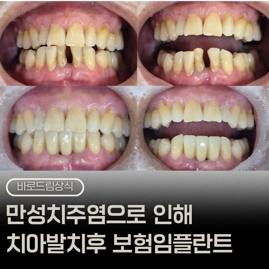 하악 앞니 상실과 치료 전후를 배치한 원문 대표 이미지