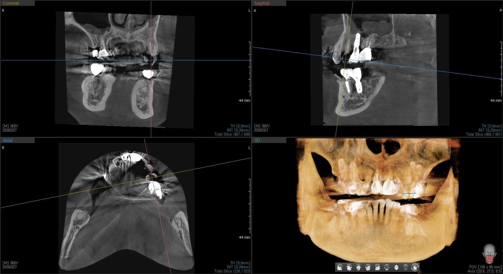 세 번째 사례의 치근 파절 확인에 제시된 CBCT 자료 1