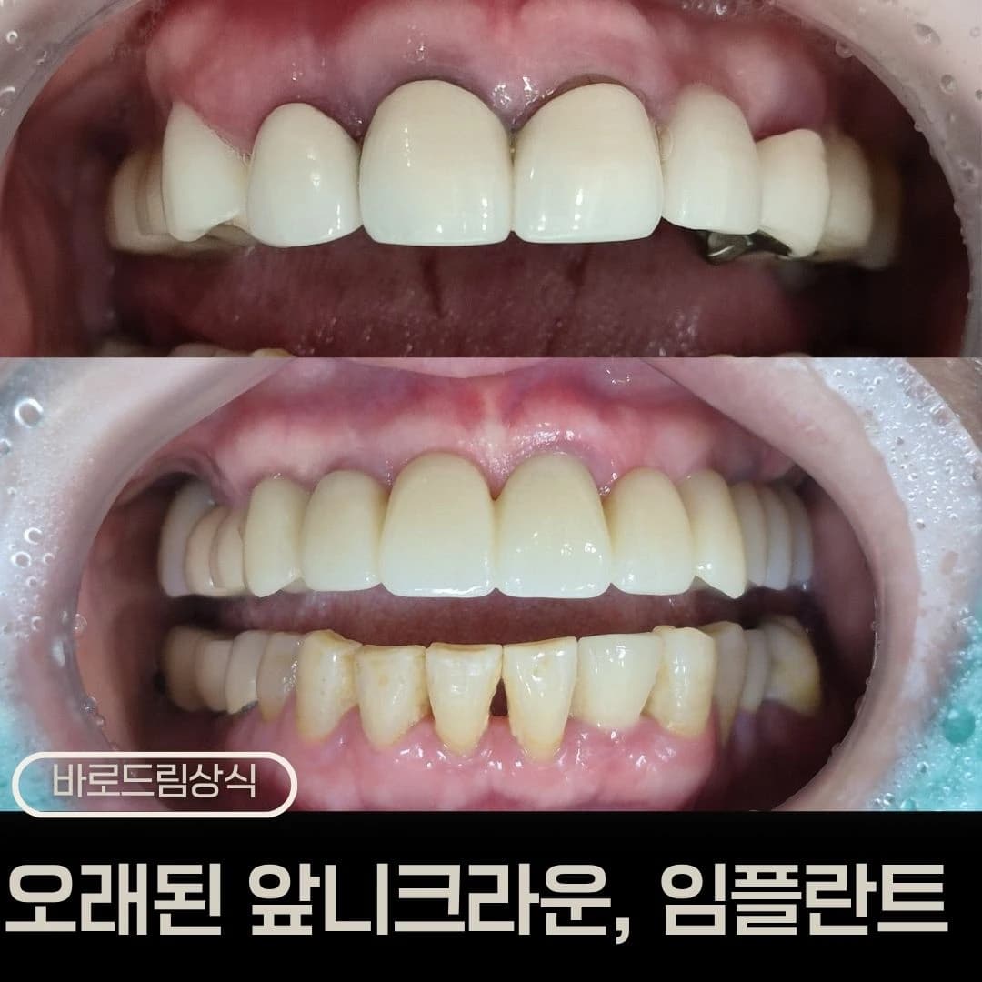 오래된 앞니 보철물 치료 전후를 배치한 원문 비교 이미지