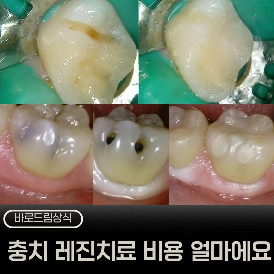 레진 치료 전후 구강사진을 모은 원문 표지