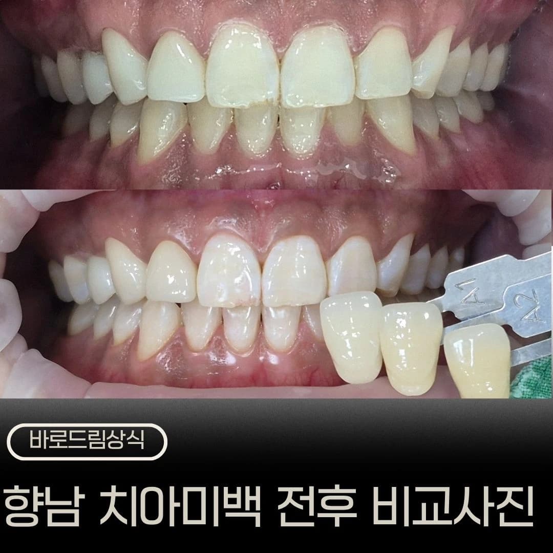 치아미백 전후 구강사진을 배치한 원문 대표 이미지